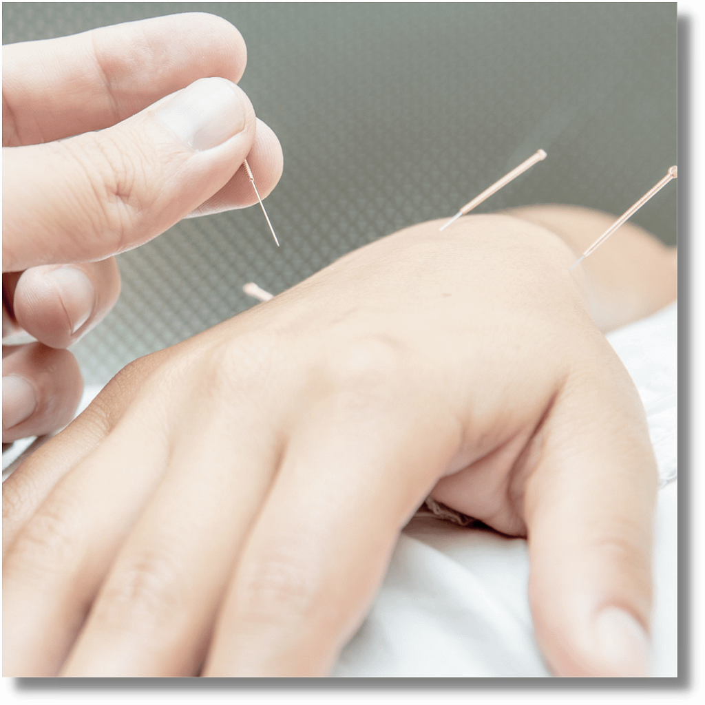 hand acupuncture